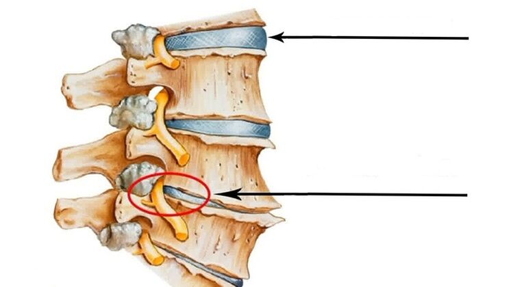 Injury to the spine in cervical osteochondrosis