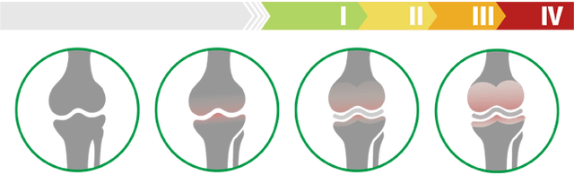 Clinical stages of knee osteoarthritis (degree of osteoarthritis of the knee joint)