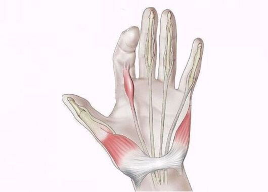 Inflammation of the tendons as a cause of pain in the finger joints