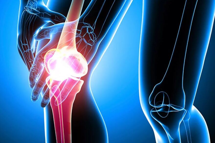Knee osteoarthritis
