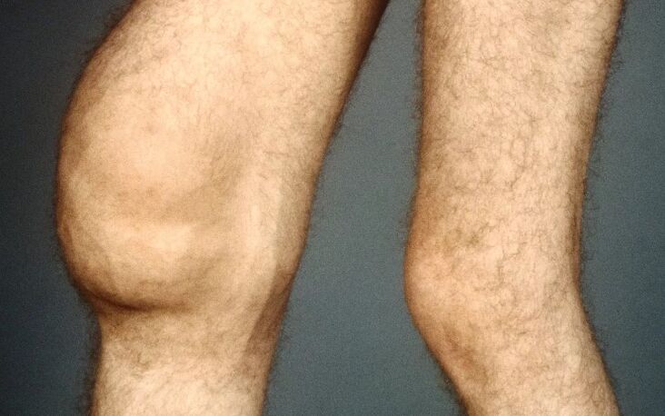 Post -Traumatic osteoarthritis of the knee joint