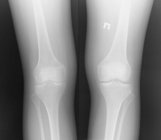 The X -ray image of the knee joint