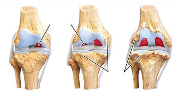 Complications of the arthrosis of the joints
