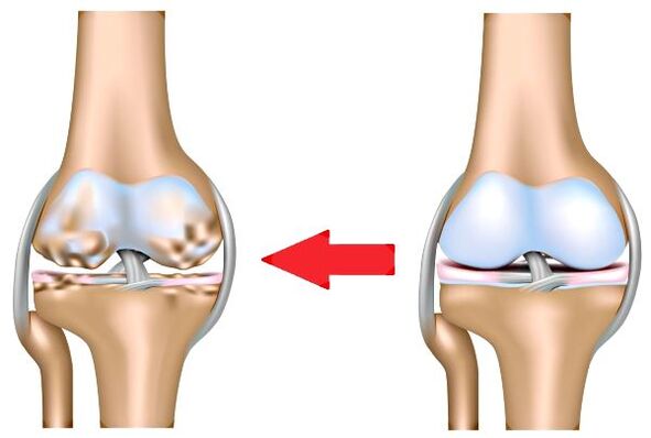 Healthy joints and osteoarthritis