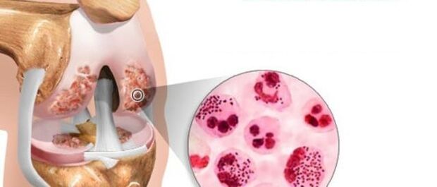 This leads to the development of osteoarthritis