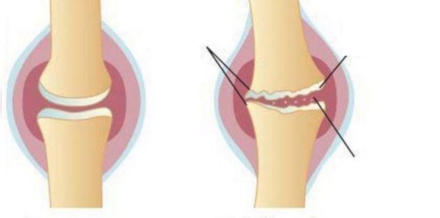 Wash cartilage