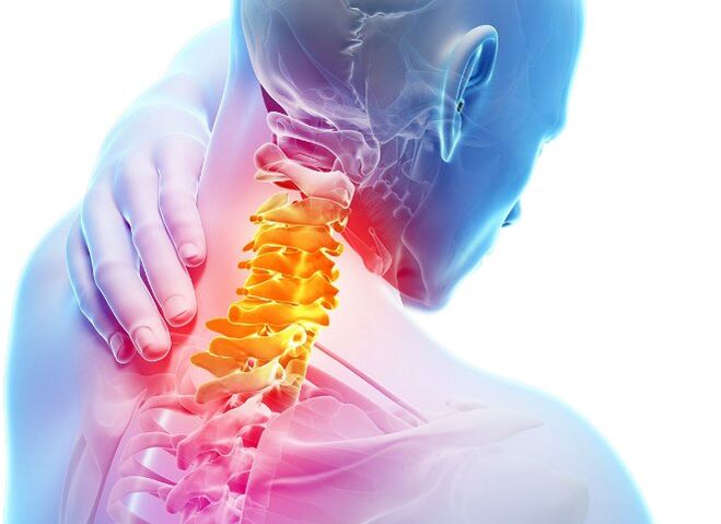 Symptoms and stages of the development of cervical osteochondrosis