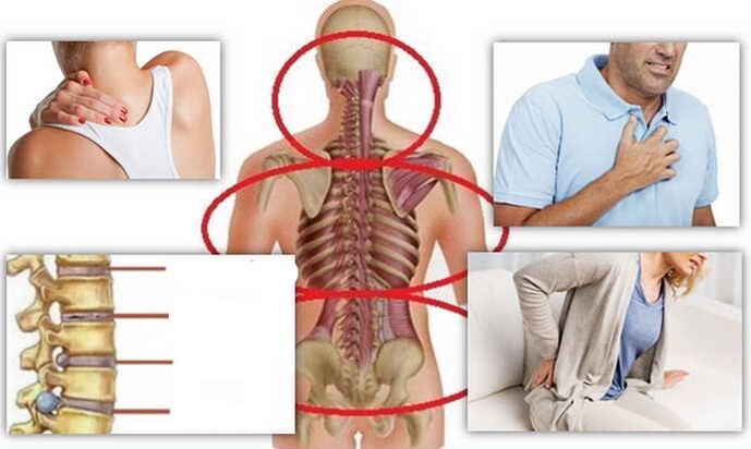 Locations of disease for osteochondrosis