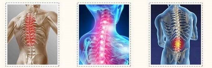 Osteochondrosis spine lesions