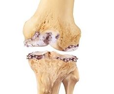 Damage to the knee joint due to osteoarthritis